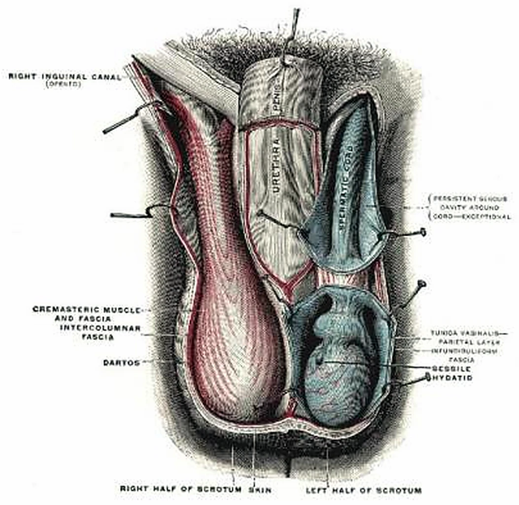 Esquema de la hernia inguinal.