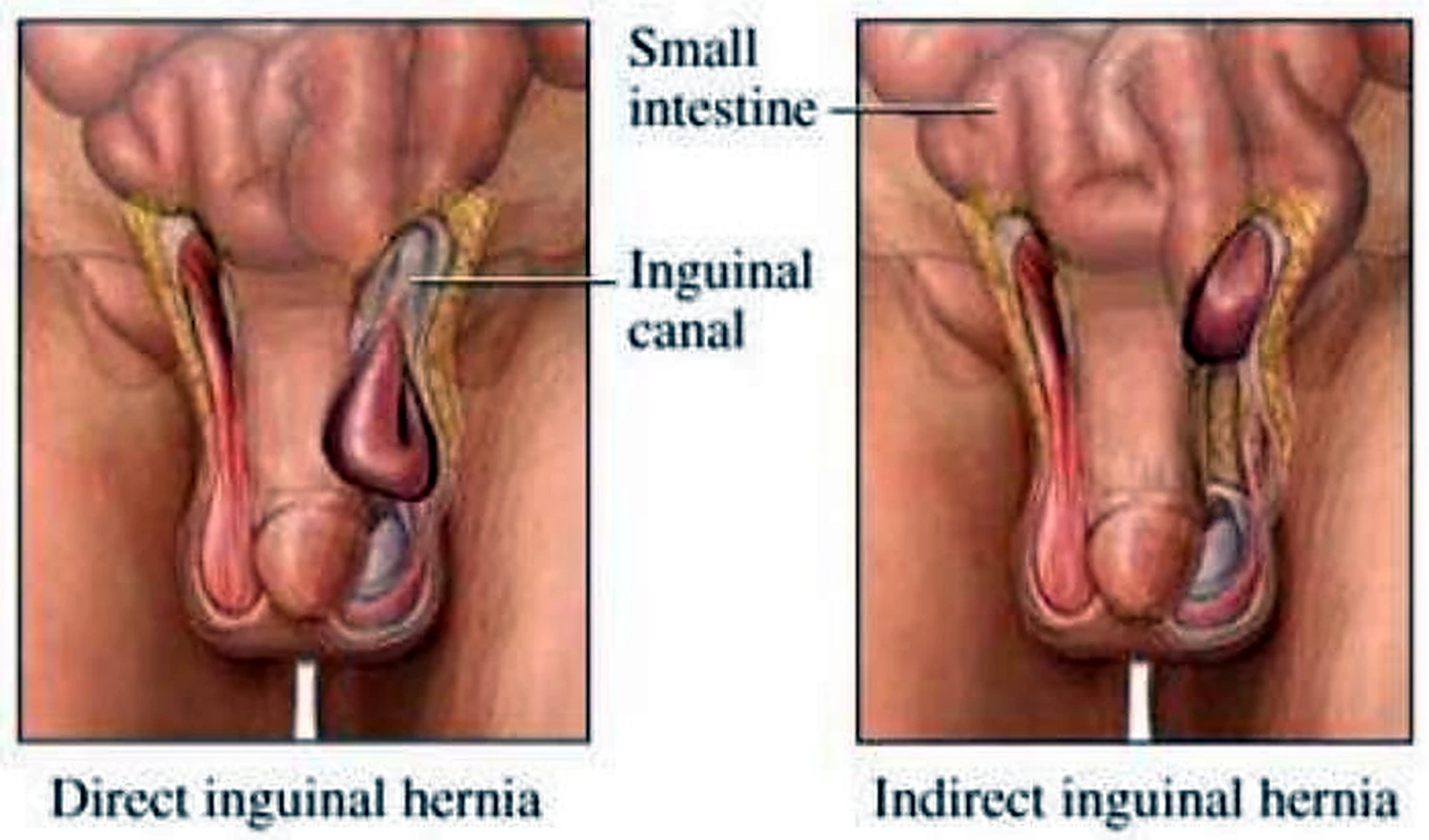 Imagen de la diferencia entre los tipos de hernia.