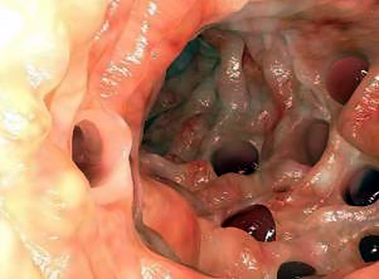 Imágenes radiológicas del colon.