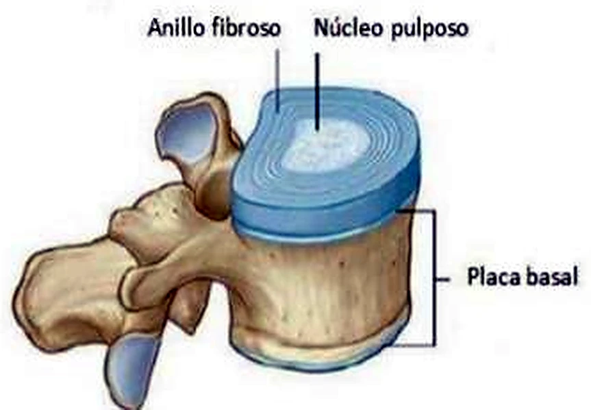 Una vértebra lumbar de lado, con un disco azul encima con la mitad en blanco.
