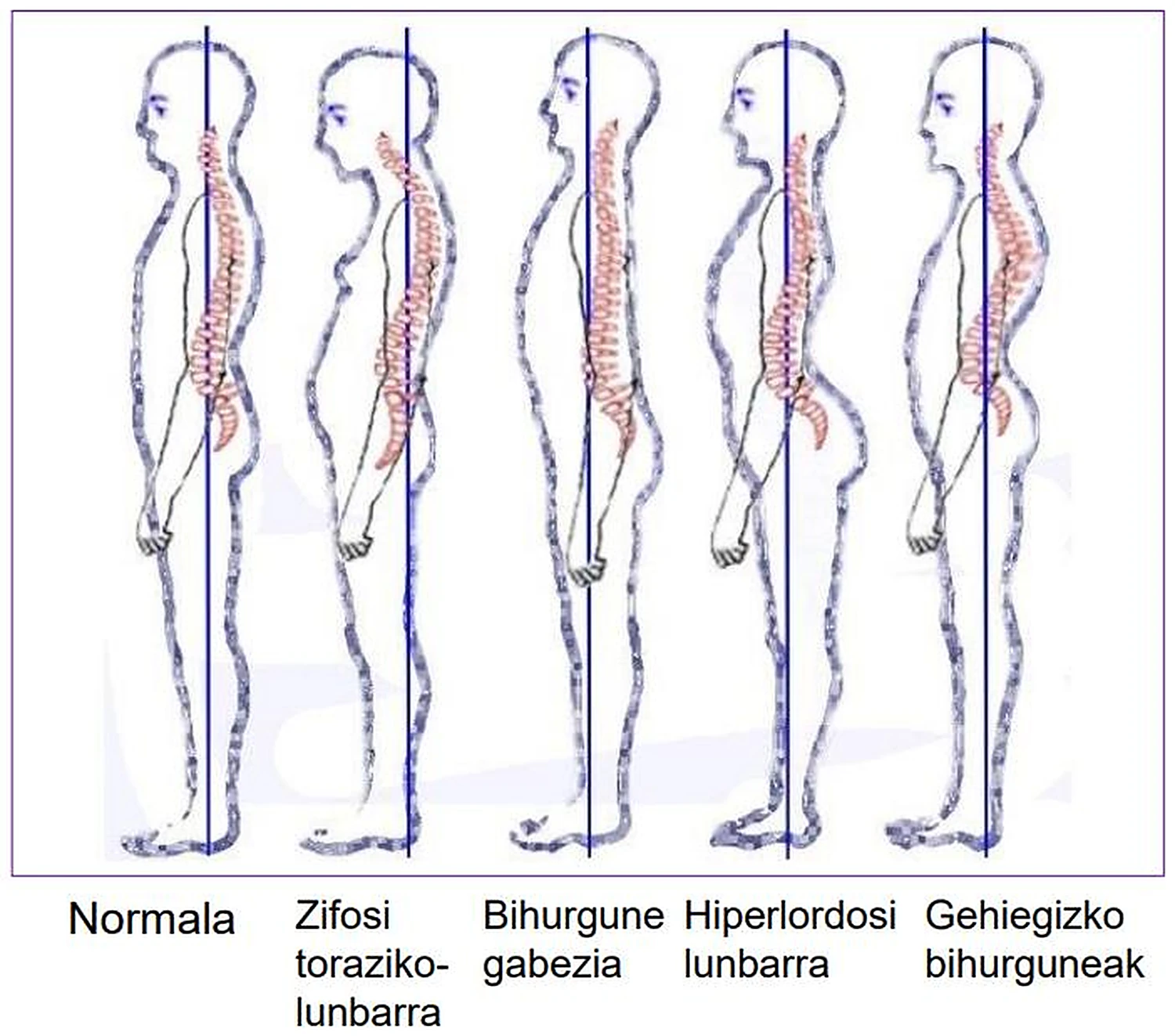 Cinco siluetas humanas de lado, con la columna vertebral en rojo y una línea vertical azul, cada una con curvaturas distintas.