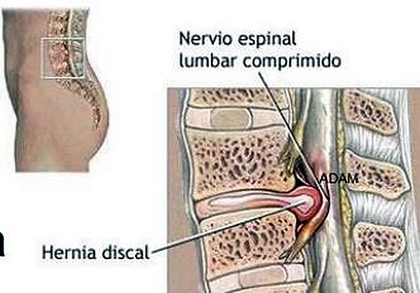 La cintura de lado y el detalle de un corte de la columna lumbar, con un disco saliendo sobre un nervio.