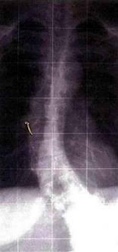 Una radiografía de tórax, con la columna vertebral curvada hacia un lado.