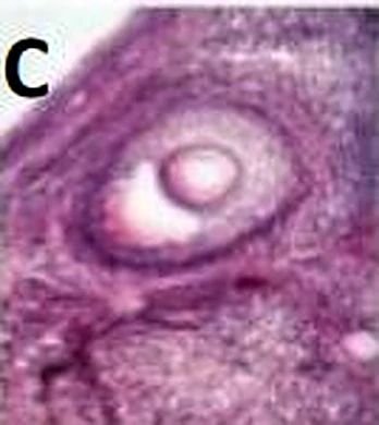 Imagen de microscopio: un folículo con una zona clara dentro.