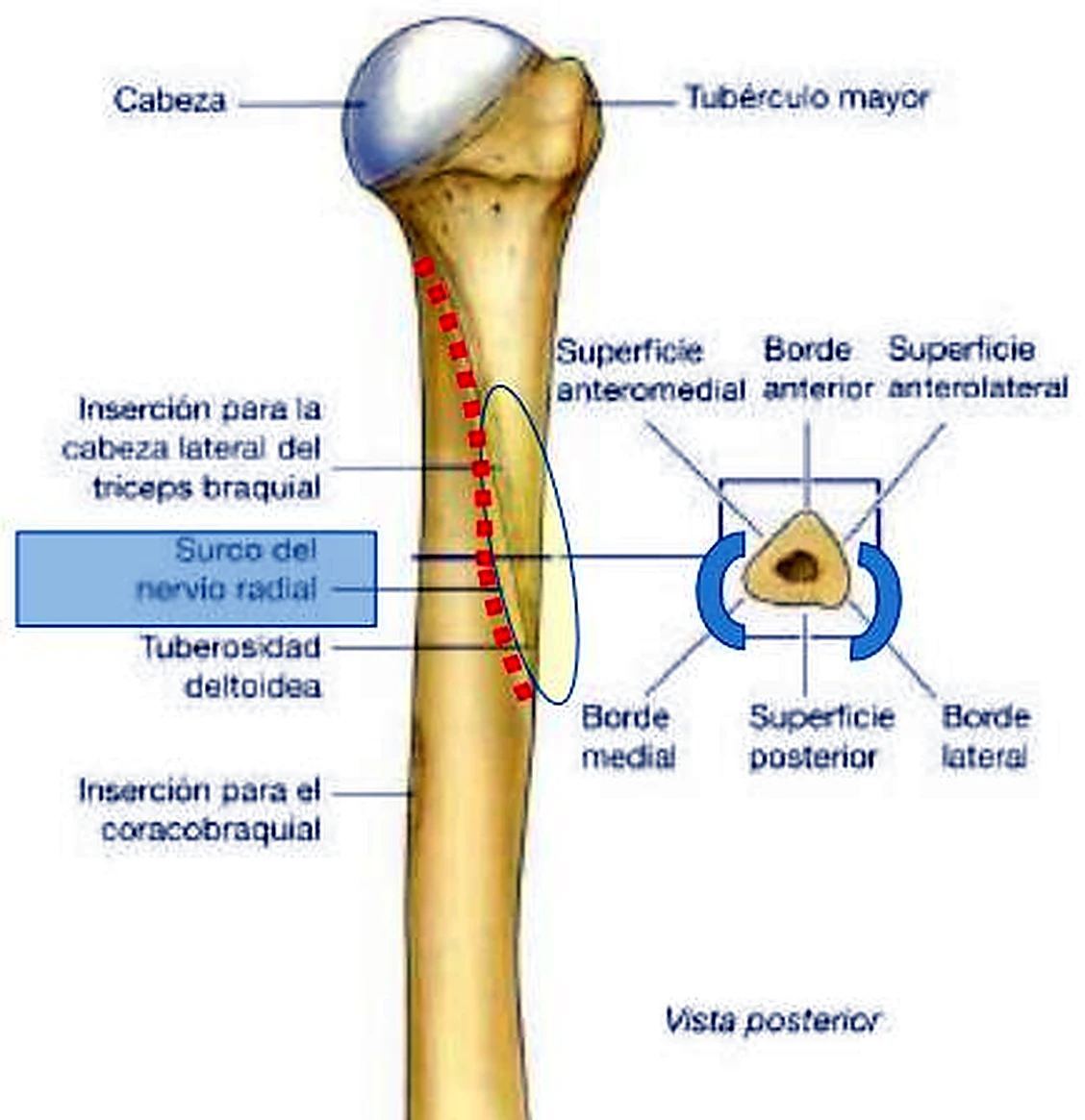 El húmero por detrás, con el surco espiral marcado en rojo y un corte triangular al lado.