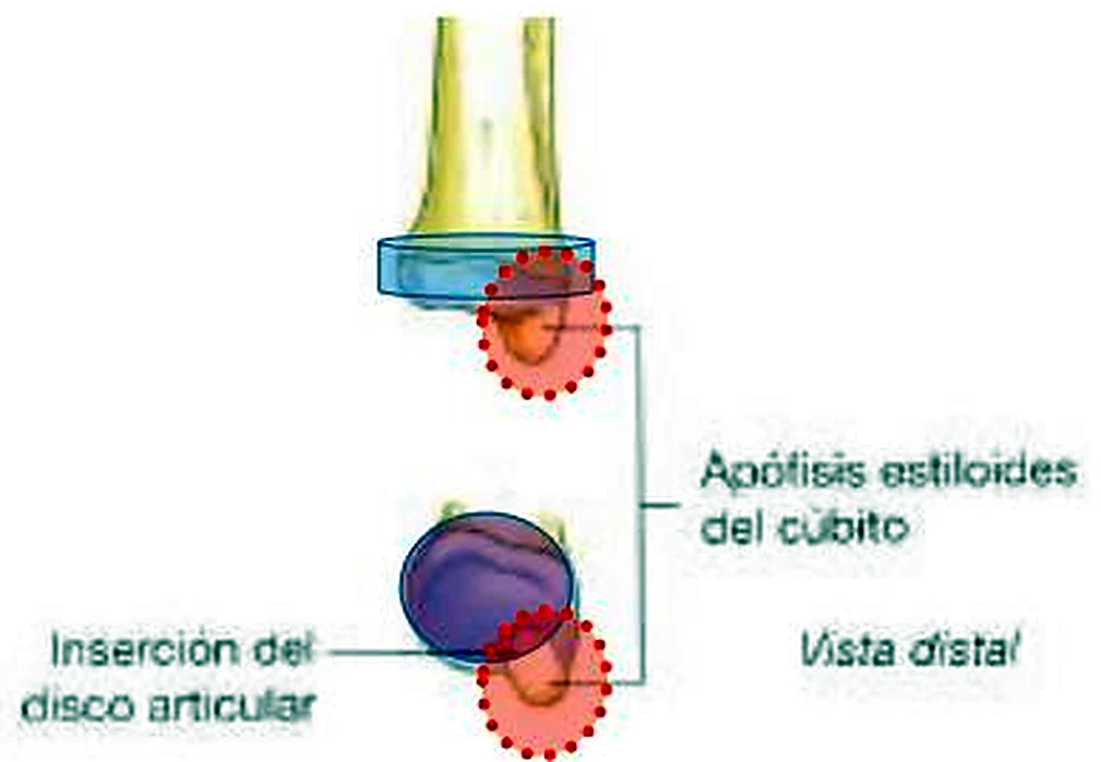 La parte inferior del cúbito de lado y desde abajo, con una zona marcada en rojo.