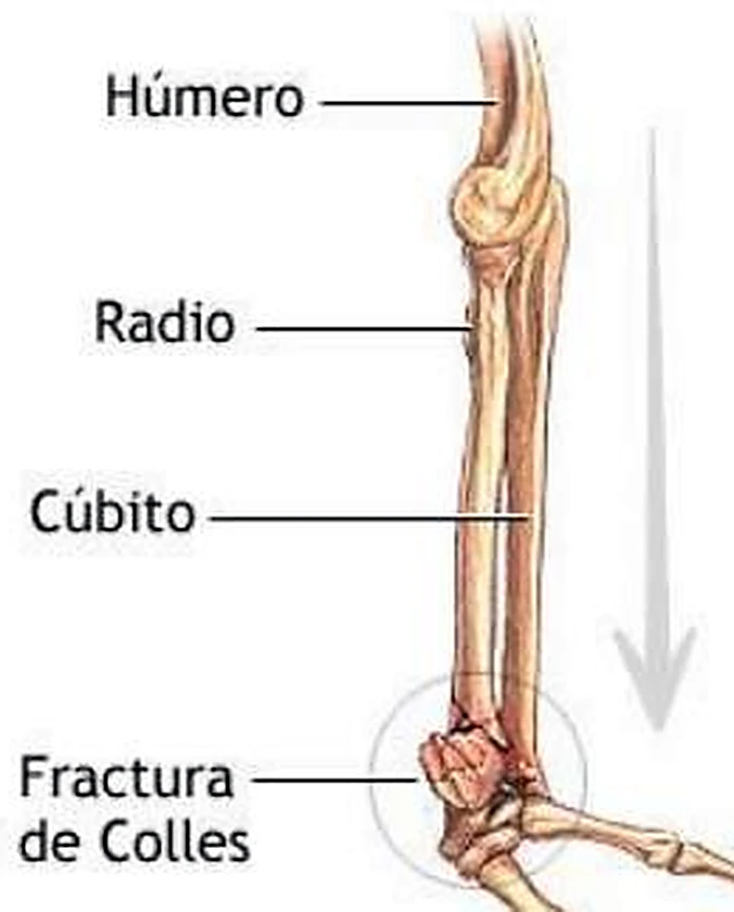 El brazo visto de lado, con una muñeca fracturada en la parte inferior marcada con un círculo.