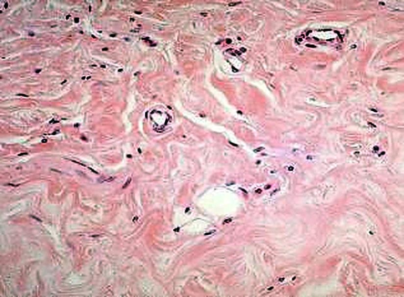 Imagen de microscopio: masas rosadas retorcidas y algunos agujeros redondos.