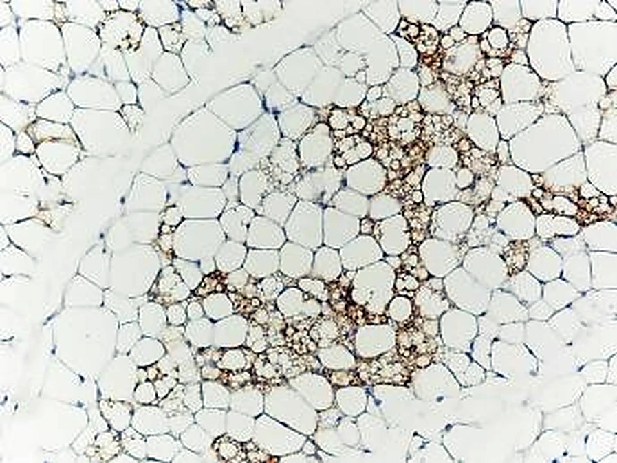 Imagen de microscopio: células blancas grandes y en el centro un grupo de células pequeñas pardas.