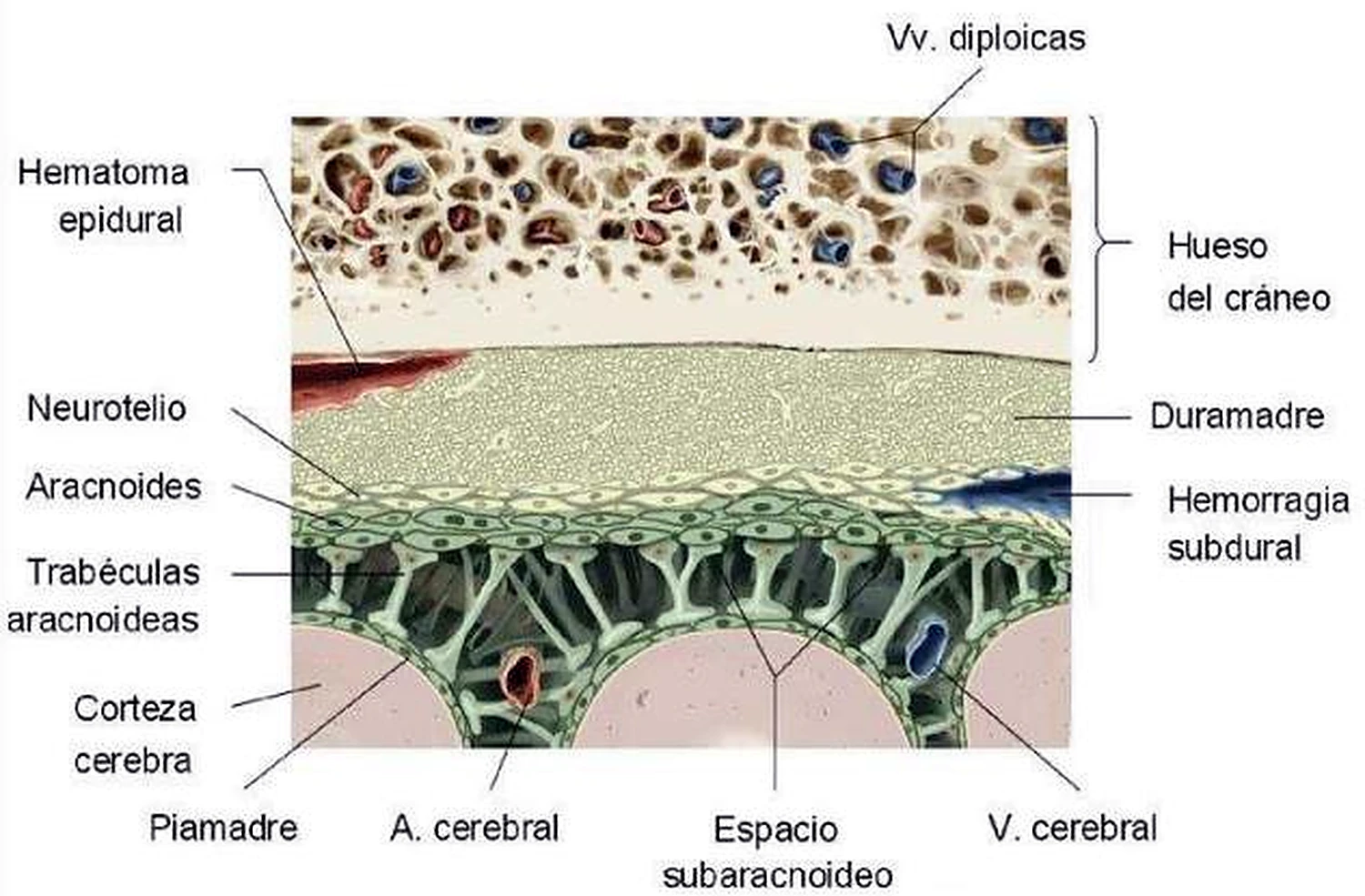 Imagen de la hemorragia epidural.