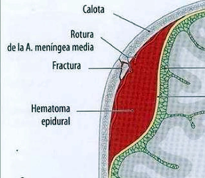 Imagen de la hemorragia subdural.