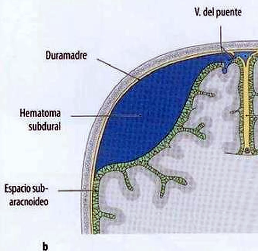 Imagen de la hemorragia subaracnoidea.